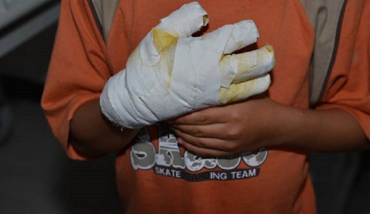 En víspera de Año Nuevo dos hombres de 30 años se quemaron con pólvora en Ibagué