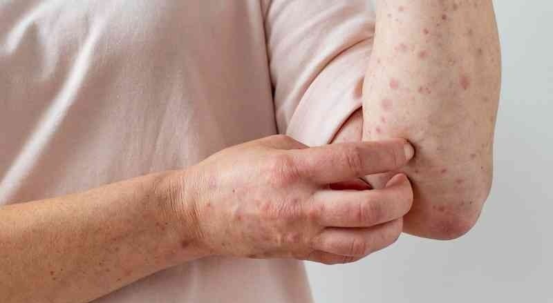 Atención: confirman el primer caso de la viruela del mono en el Tolima