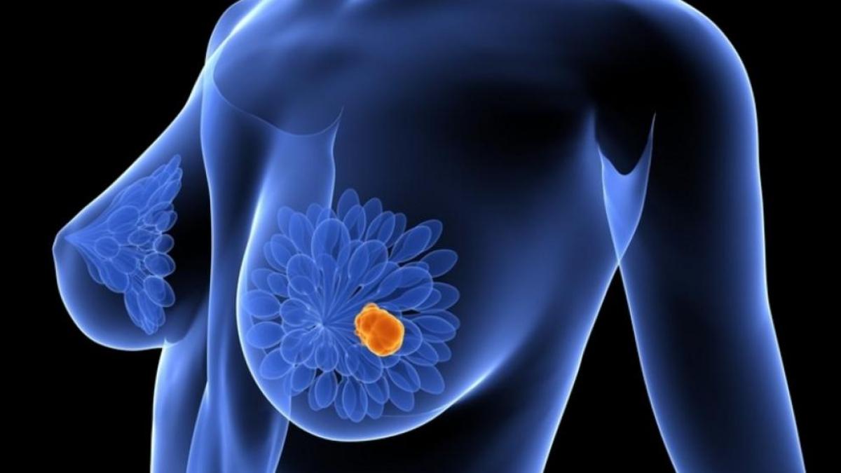 ¿El dolor mamario es un síntoma de cáncer de mama?