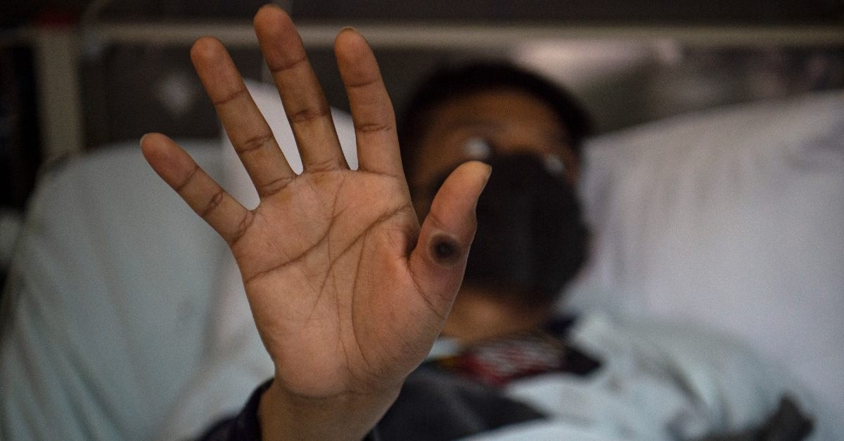 Casos de viruela del mono en Colombia llegan a los 3.630