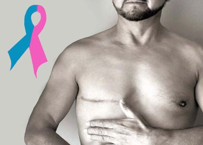 El cáncer de mama en hombres no es cuento