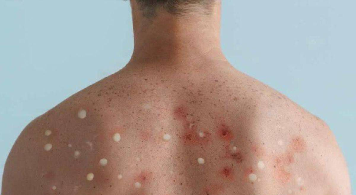 En investigación muerte de un joven contagiado con viruela símica