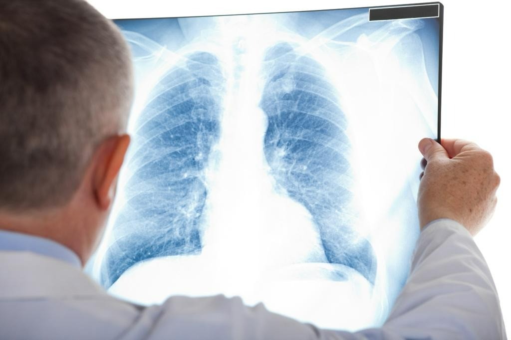 Tabaquismo: principal causa de cáncer de pulmón y EPOC