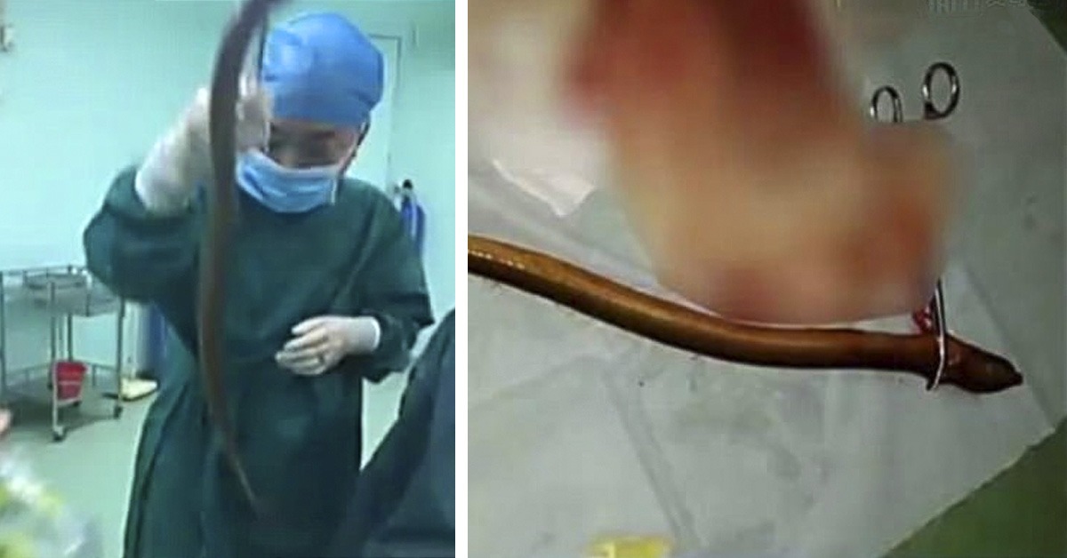 Extirpan una anguila del intestino a un hombre que la introdujo por el ano contra el estreñimiento