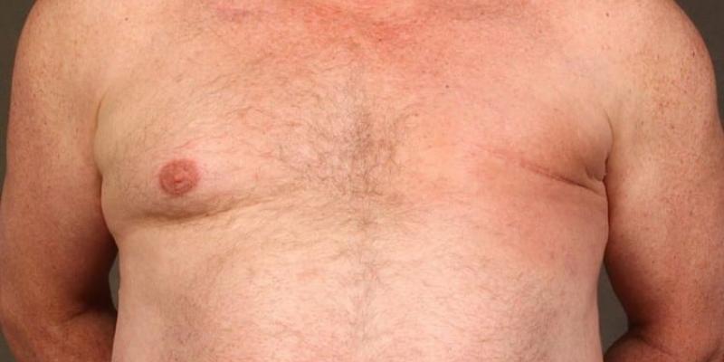 ¿El cáncer de mama puede darle a los hombres?