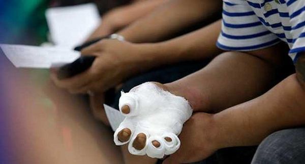25 personas sufrieron quemaduras por manipular pólvora en Navidad en el Tolima