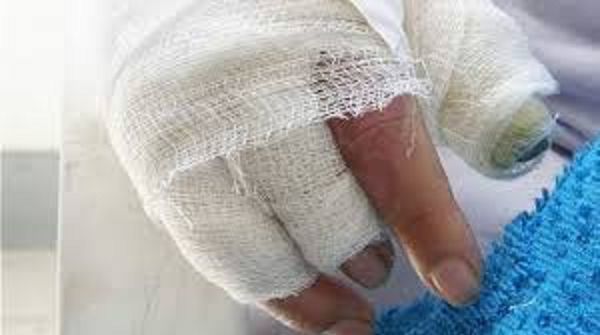 A 30 se eleva número de personas quemadas con pólvora en el Tolima