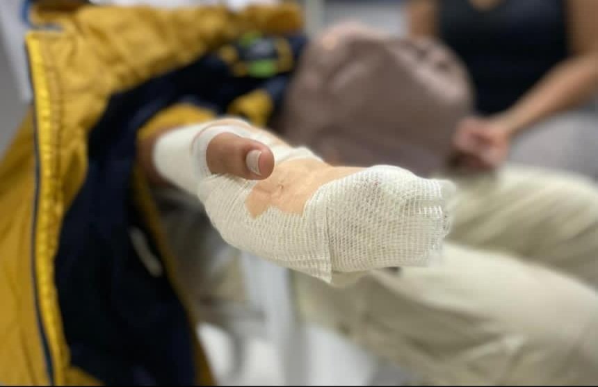 Joven casi pierde la mano por jugar con una mecha en Ibagué