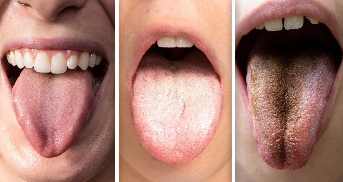 La lengua da señales de su estado de salud