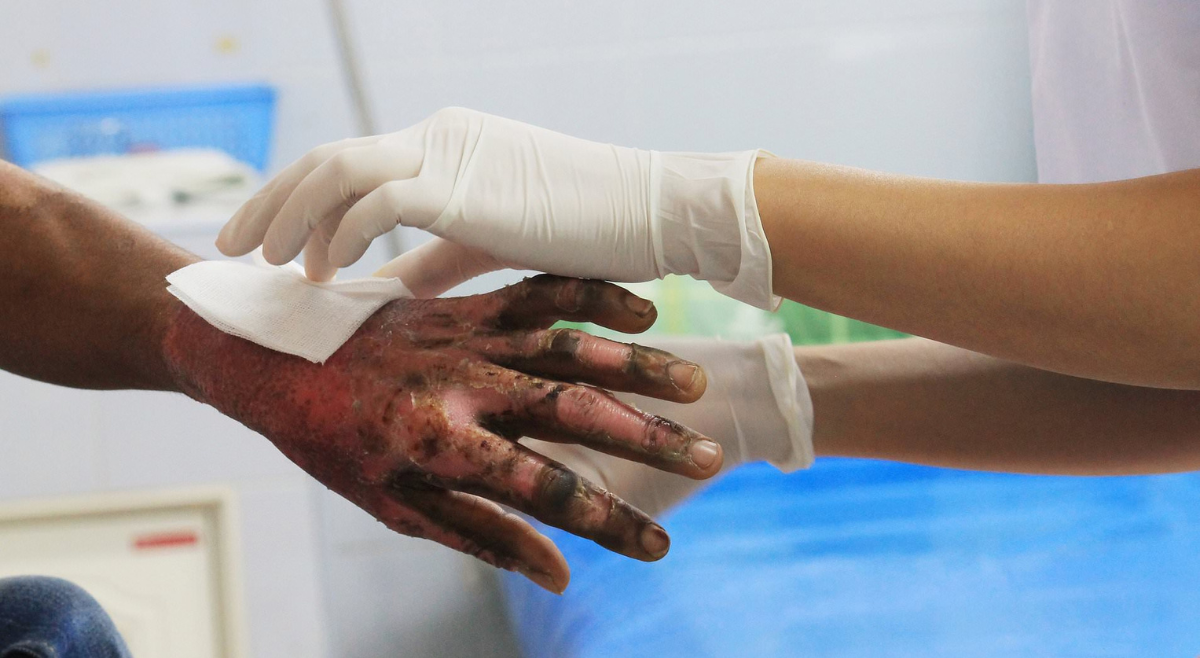 Primer quemada por pólvora de este año en Ibagué: una adolescente de 16 años