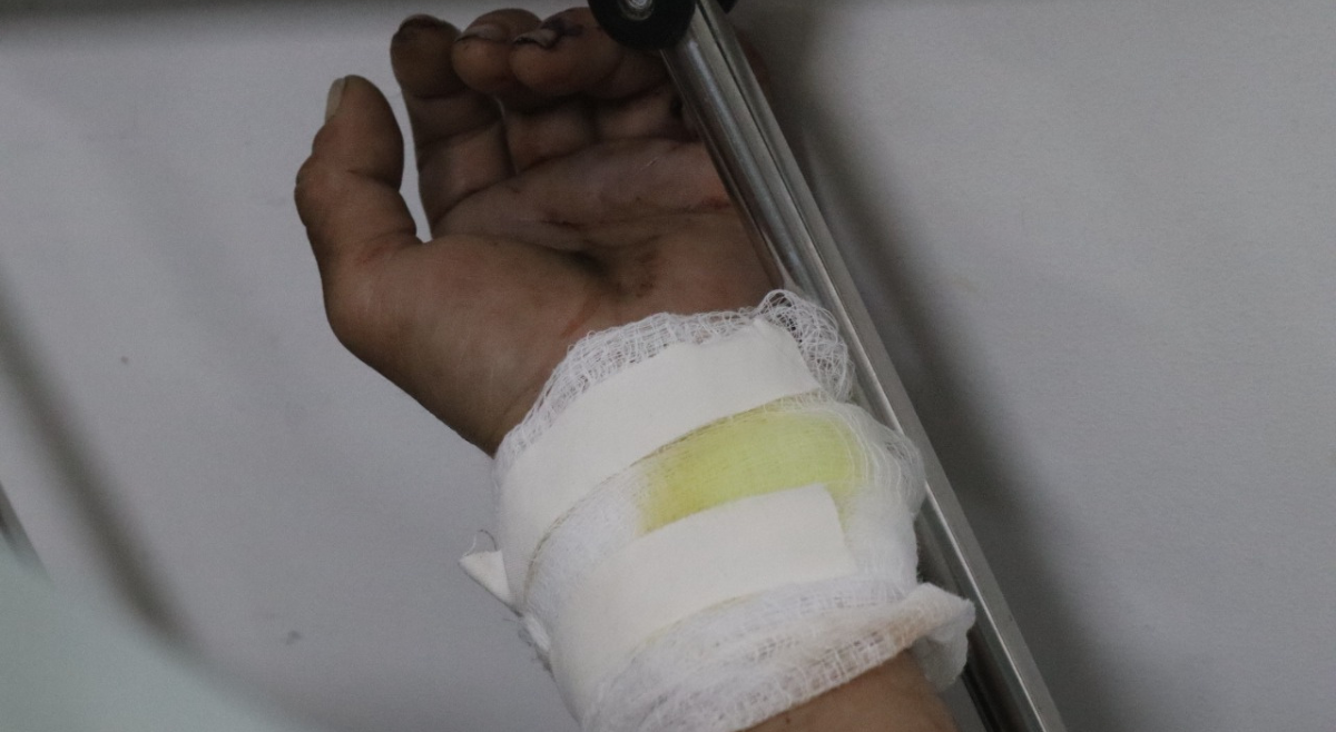 ¿Qué hacer frente a una quemadura con pólvora?