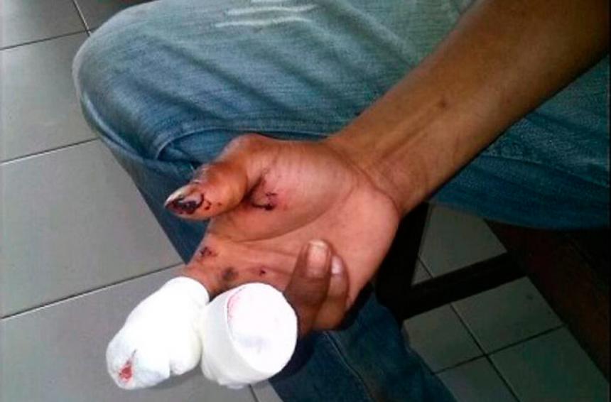El Tolima acumula 62 quemados por pólvora