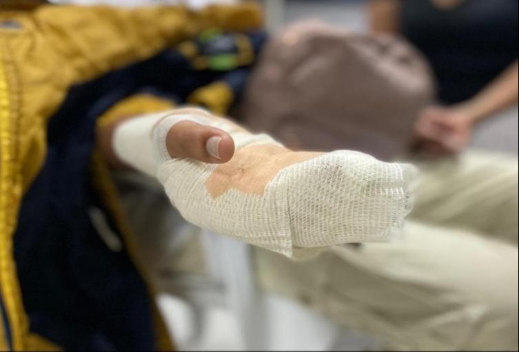 Un hombre de 33 años, el tercer quemado con pólvora en Ibagué