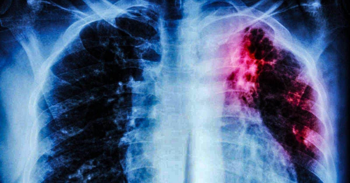 Ojo, la tuberculosis todavía existe