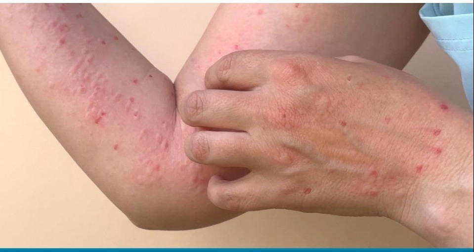 Tolima, tercer departamento con más casos de viruela del mono