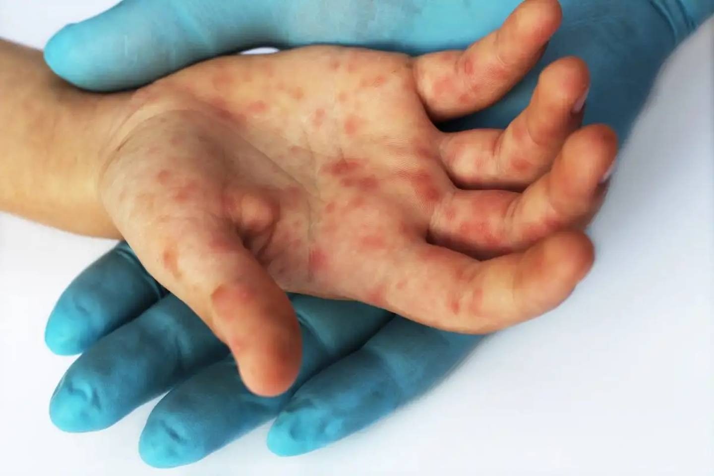 Tenga en cuenta los síntomas y cómo se transmite la viruela del mono