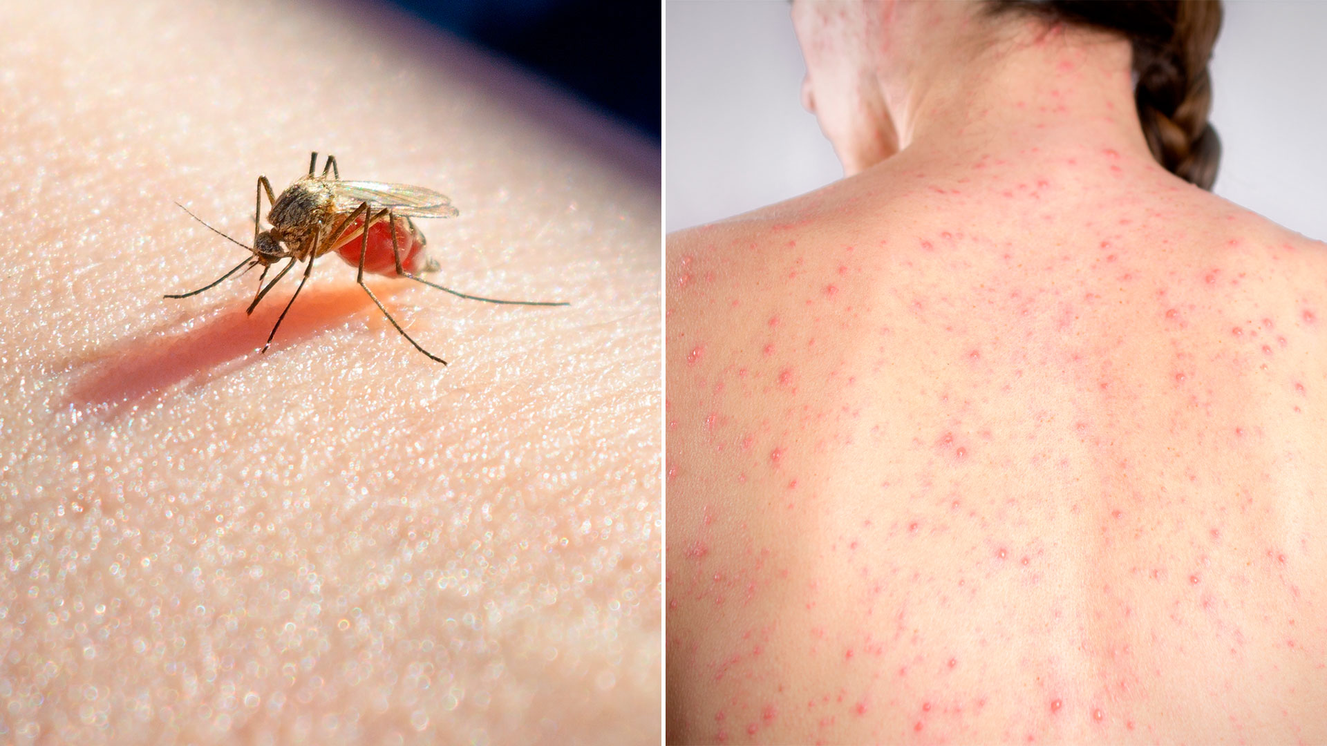Los cuidados especiales con el dengue grave